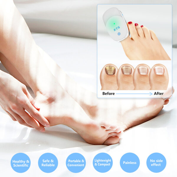 KTS Nail Fungus Laser Therapy Device 905nm 470nm Fungal Nail Treatment for Fingernails Toenails Onychomycosis Cure 4
